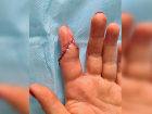 В Ростове врачи пришили женщине палец, отрубленный дверью