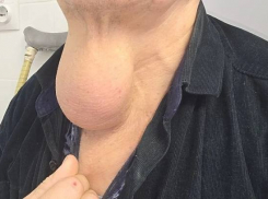 Ростовские хирурги удалили опухоль размером с апельсин на шее у мужчины