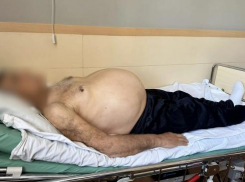 Врачи удалили опухоль весом 15 кг у пациента из Ростовской области