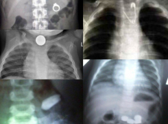 Топ-5 предметов, которые медикам пришлось извлекать из желудков детей в Ростовской области