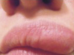 Шевелящегося под кожей червя достали из лица молодой женщины ростовские врачи