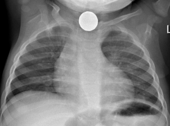 Пивную пробку проглотил оставленный без присмотра трехлетний малыш в Ростове 