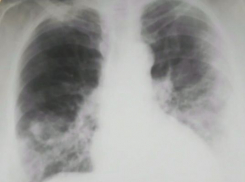 Пять человек за сутки умерли от коронавируса в Ростовской области