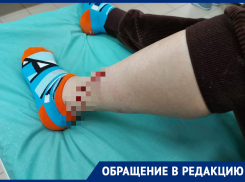 «Страшно выходить на улицу»: в Первомайском районе Ростова женщину чуть не растерзала бездомная собака