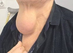 Ростовские хирурги удалили опухоль размером с апельсин на шее у мужчины