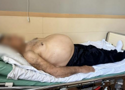 Врачи удалили опухоль весом 15 кг у пациента из Ростовской области