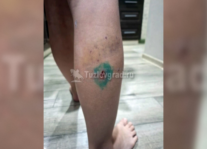 На школьницу напали бездомные собаки и прокусили ногу в Новочеркасске