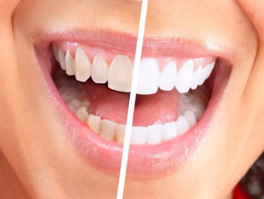 Белоснежную улыбку подарят ростовские стоматологи своим пациентам
