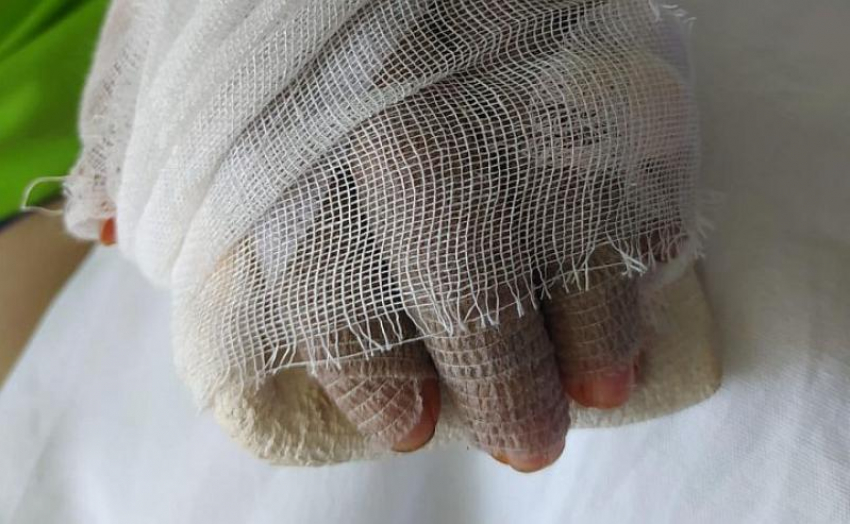 В Ростове врачи спасли отрубленную гильотиной кисть руки у женщины-кондитера