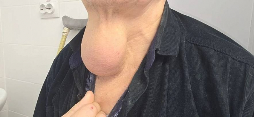 Ростовские хирурги удалили опухоль размером с апельсин на шее у мужчины