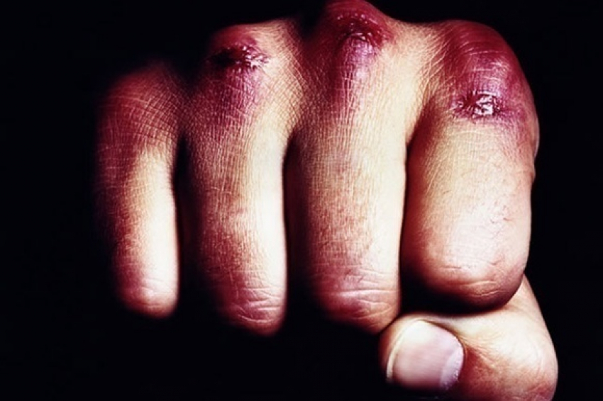 Посетитель ресторана сломал нос ростовчанке во время празднования Рождества