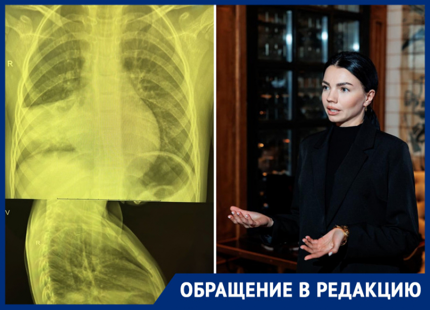 В Ростове у маленькой девочки в частной медицинской клинике не заметили пневмонию
